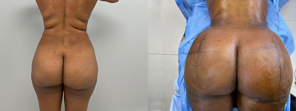 Brazilian Butt Lift before and after photo