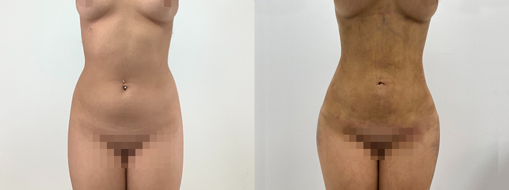 Liposuction before and after photo