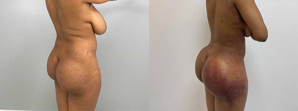 Brazilian Butt Lift before and after photo