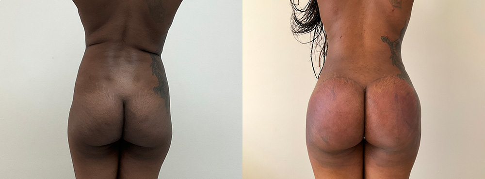 Brazilian Butt Lift Before and After