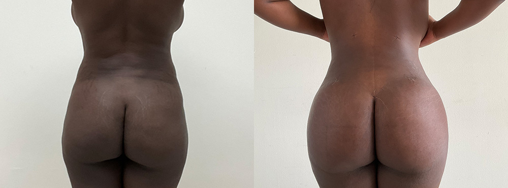 Brazilian Butt Lift Before and After 