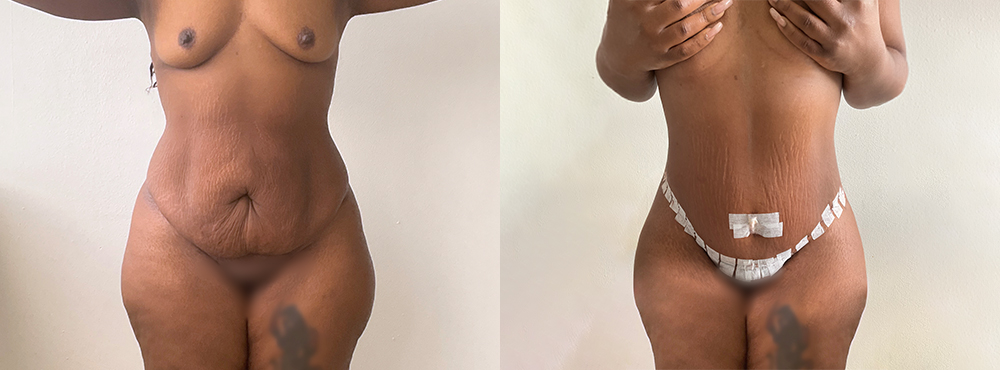 Tummy Tuck Before and After