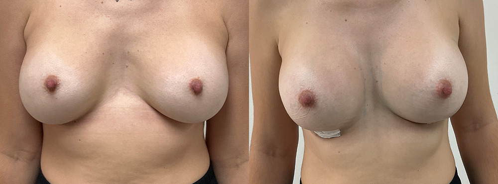 Breast Augmentation Before and After