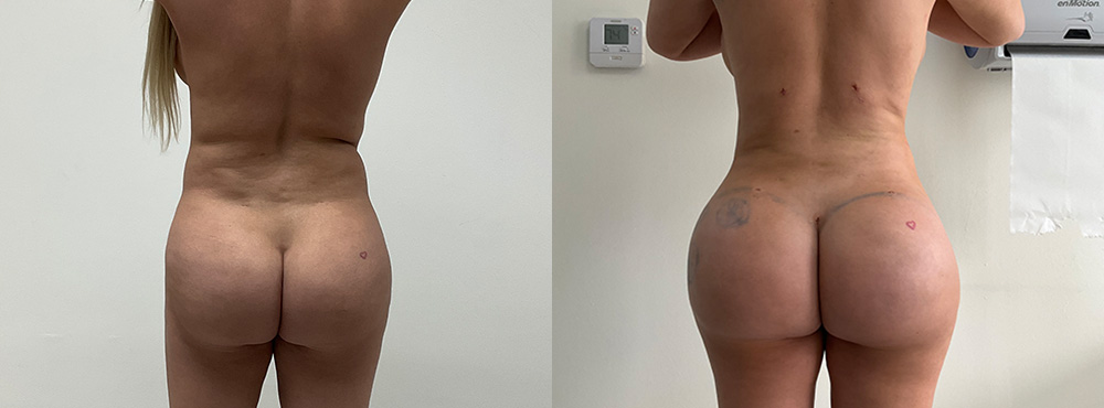 Brazilian Butt Lift Before and After in Miami