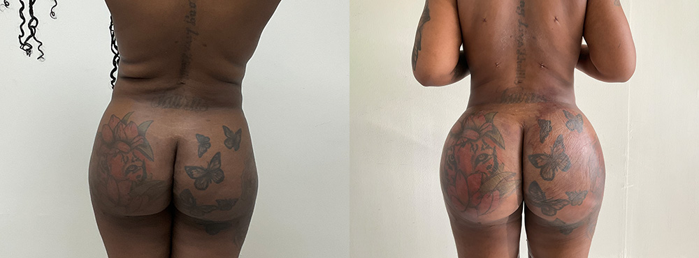 Brazilian Butt Lift Before and After in Miami