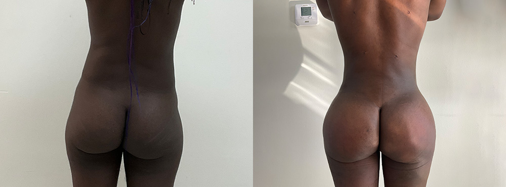 Brazilian Butt Lift Before and After