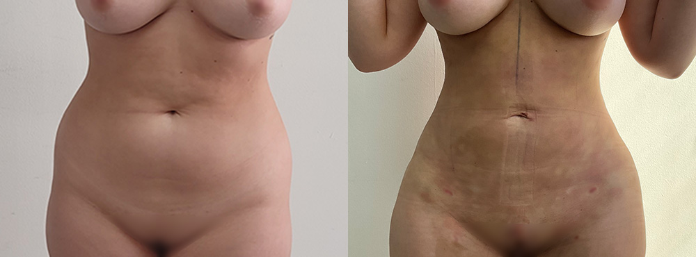 Liposuction Before and After 