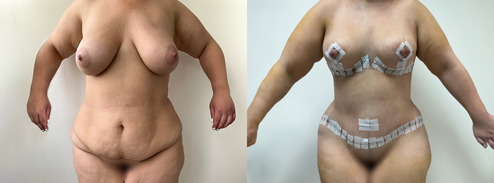 Mommy Makeover Before and After