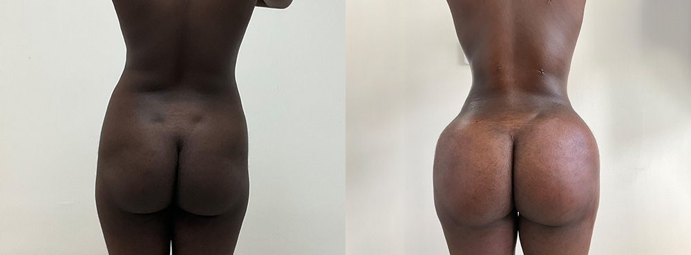 Brazilian Butt Lift Before and After
