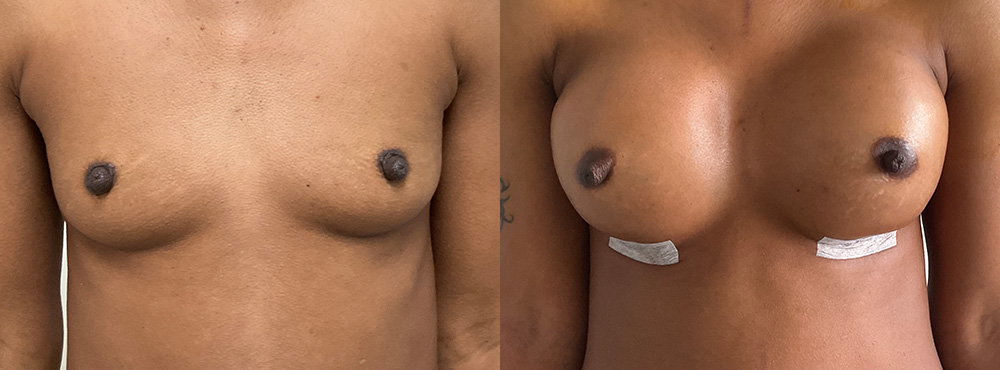 Breast Augmentation Before and After