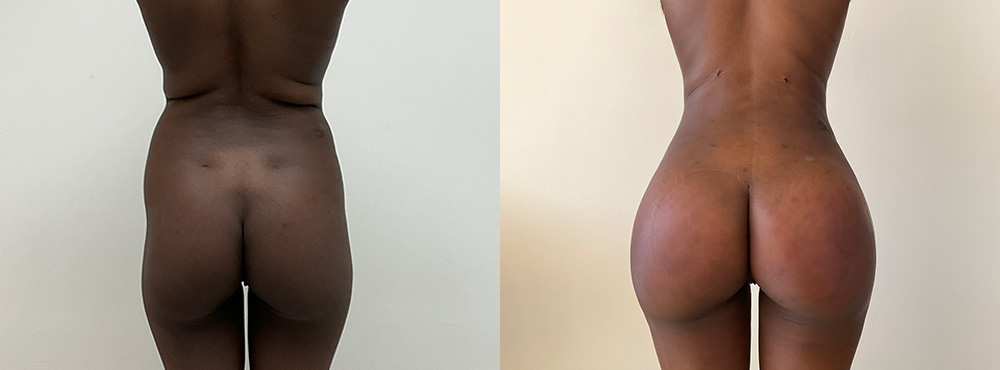 Brazilian Butt Lift Before and After