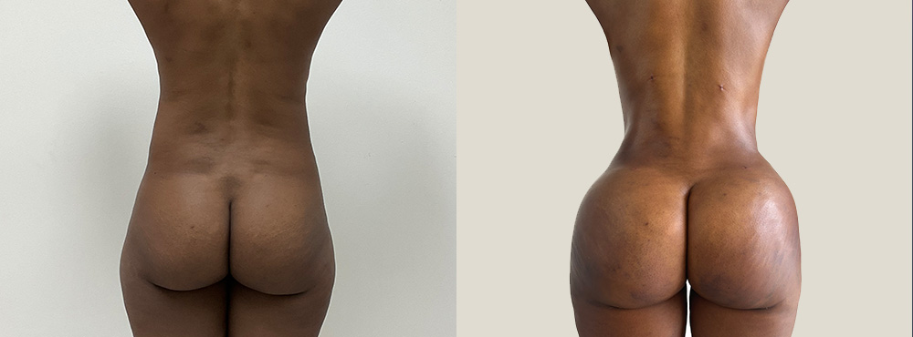 Brazilian Butt Lift Before and After in Miami