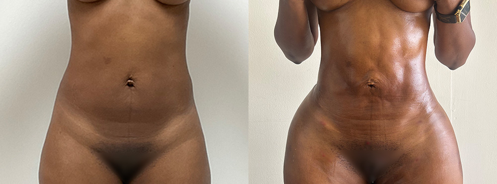Brazilian Butt Lift Before and After in Miami