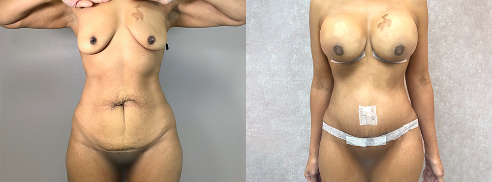 Mommy Makeover Before and After