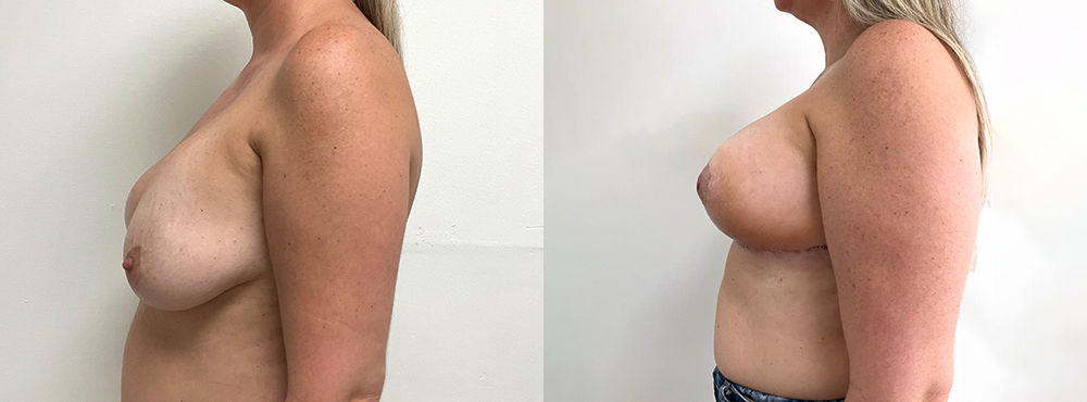 Breast  Lift Before and After
