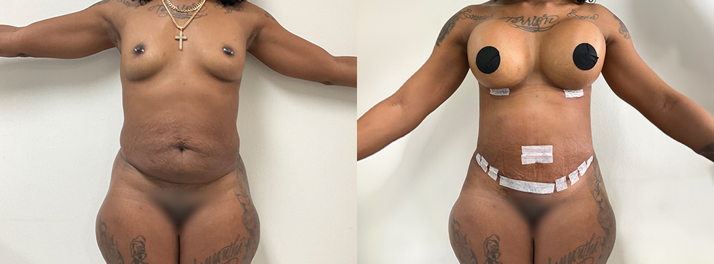 Mommy Makeover Before and After