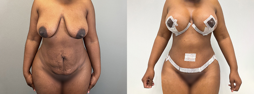 Mommy Makeover Before and After