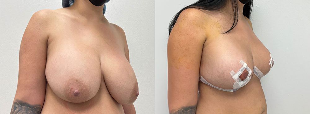 Breast Lift Before and After