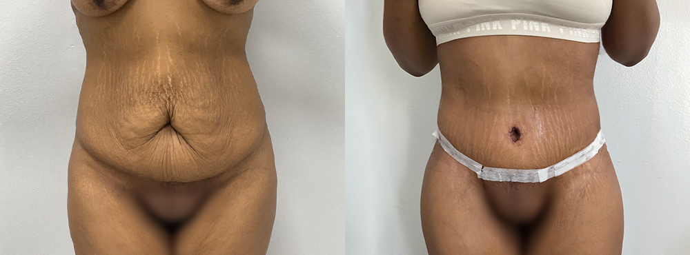 Tummy Tuck Before and After