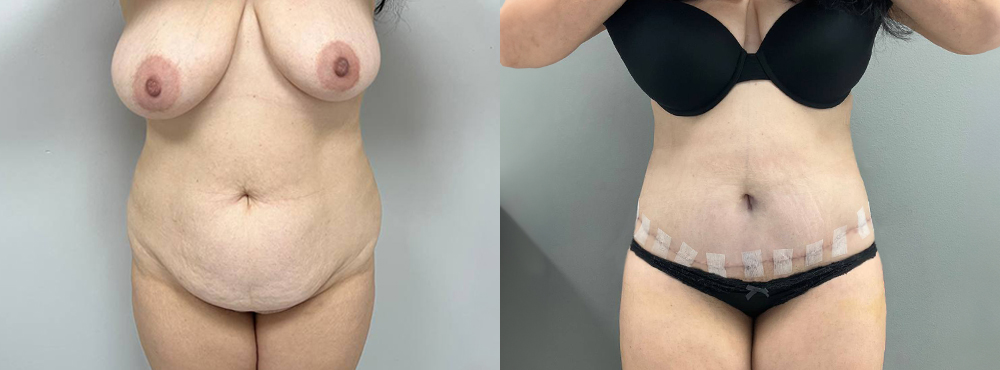 Tummy Tuck Before and After