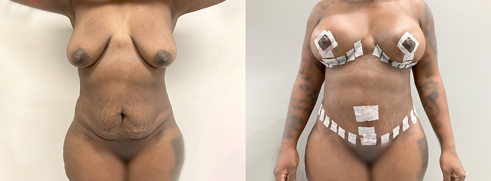 Mommy Makeover Before and After