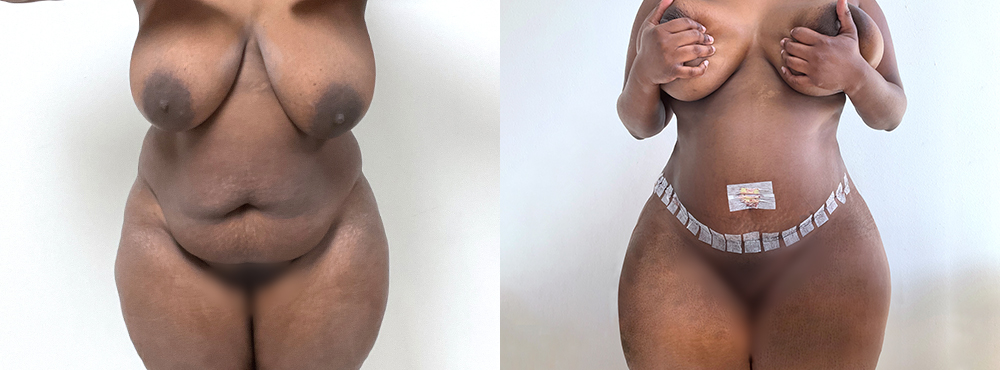 Tummy Tuck Before and After