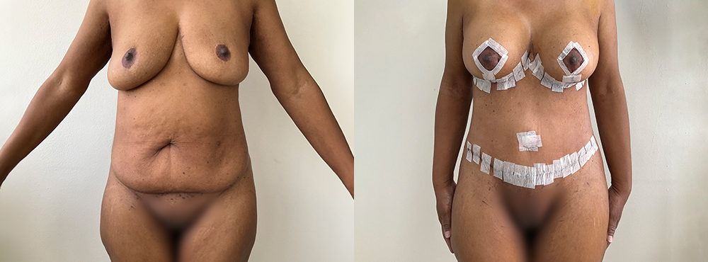 Mommy Makeover Before And After