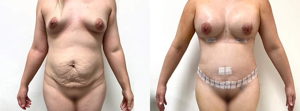 Mommy Makeover Before and After