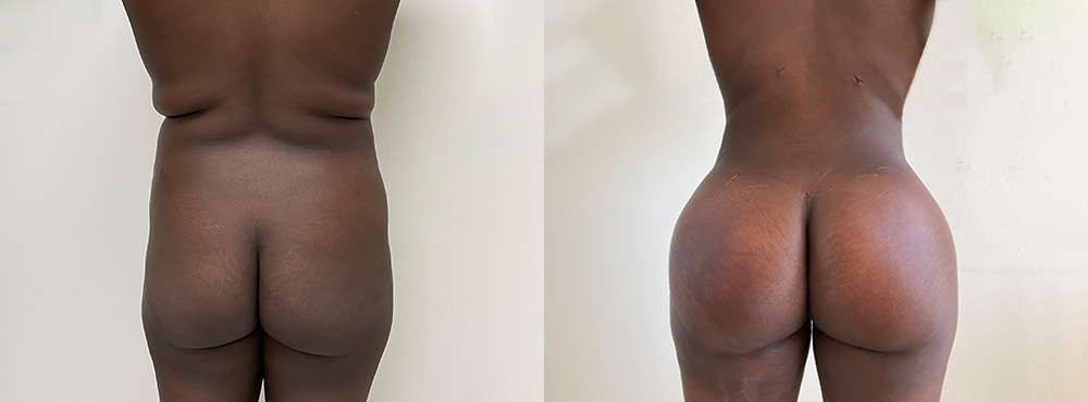Brazilian Butt Lift Before and After in Miami