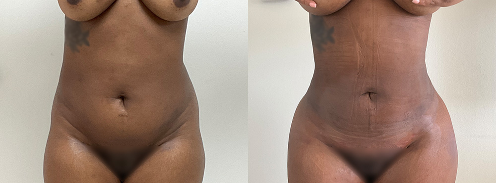 Liposuction Before and After in Miami