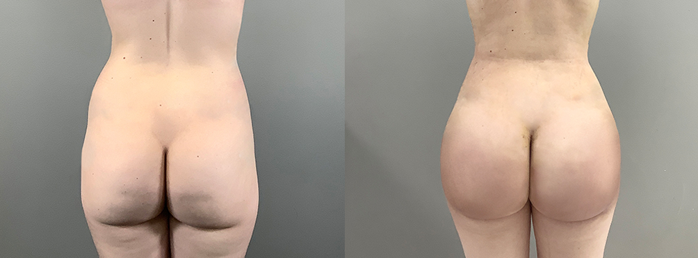 Breast Lift Before and After in Miami