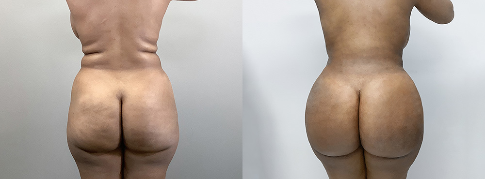Brazilian Butt Lift Before and After in Miami