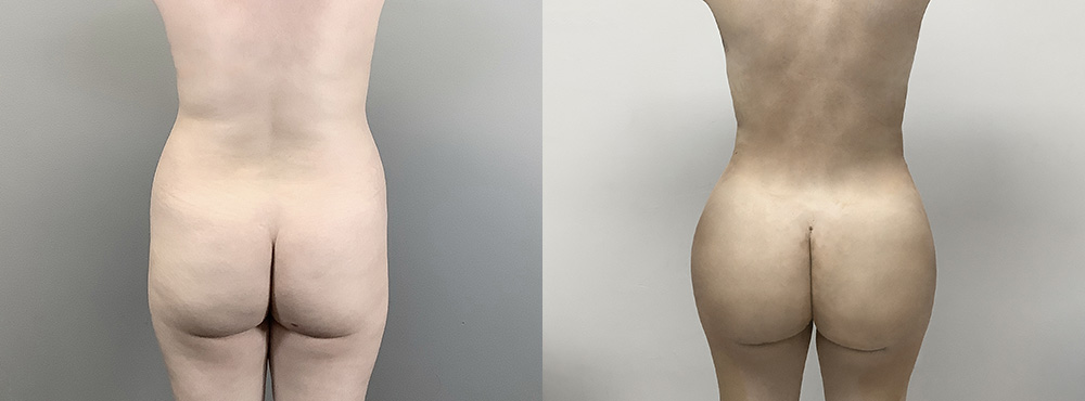 Brazilian Butt Lift Before and After in Miami