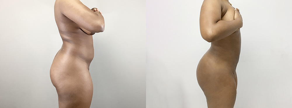 Brazilian Butt Lift Before and After in Miami