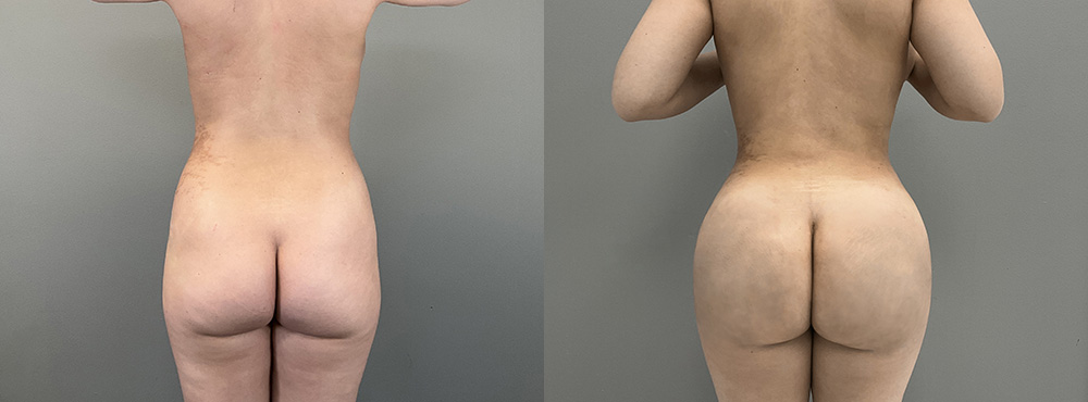 brazilian Butt lift Before and After