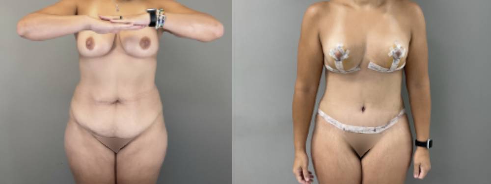 Mommy Makeover Before and After in Miami