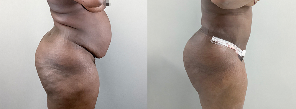Tummy Tuck Before and After in Miami