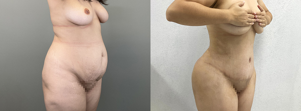 Tummy Tuck Before and after in miami