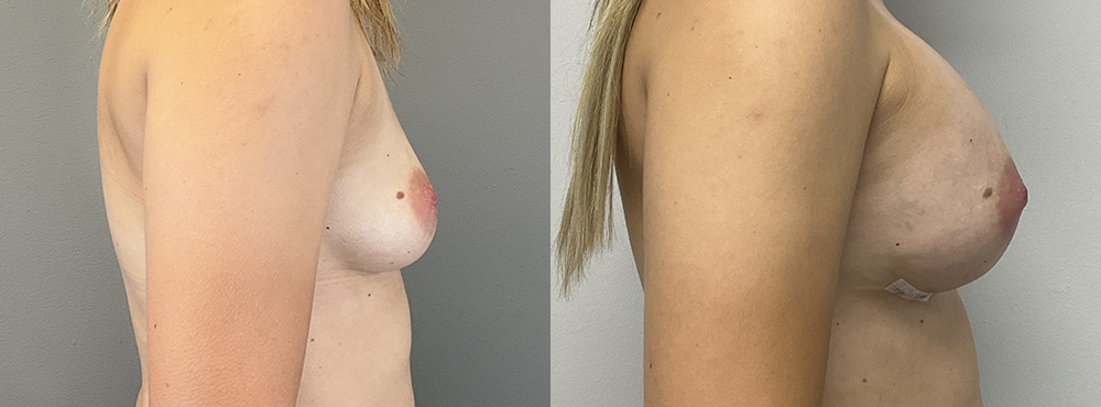 Breast Augmentation Before and After in Miami