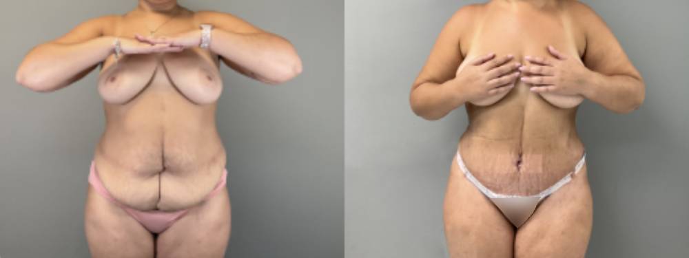 Tummy Tuck Before and After in Miami