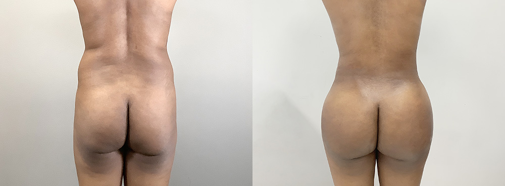 Brazilian Butt Lift Before and After 