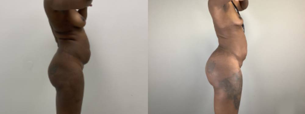 Brazilian Butt Lift Before and After in Miami