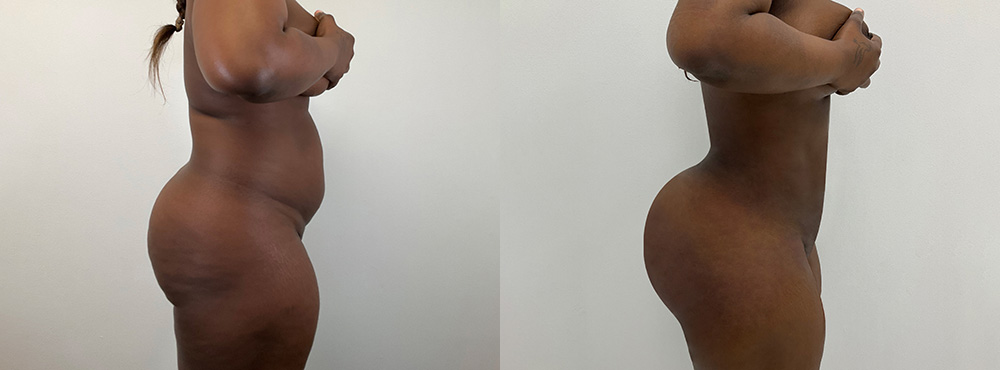 Brazilian Butt Lift Before and After in miami