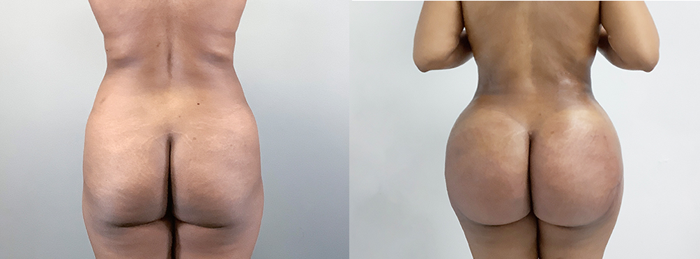 Brazilian Butt Lift Before and After