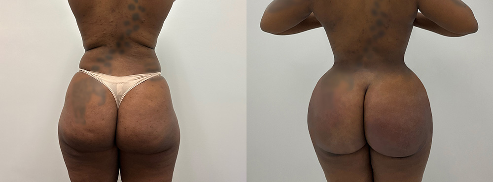 Brazilian Butt Lift Before and After in Miami