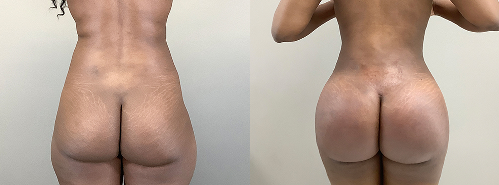 Brazilian Butt Lift Before and After in Miami