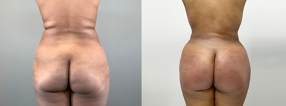 Brazilian Butt Lift Before and After in Miami