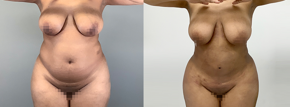 Brazilian Butt Lift Before and After in Miami