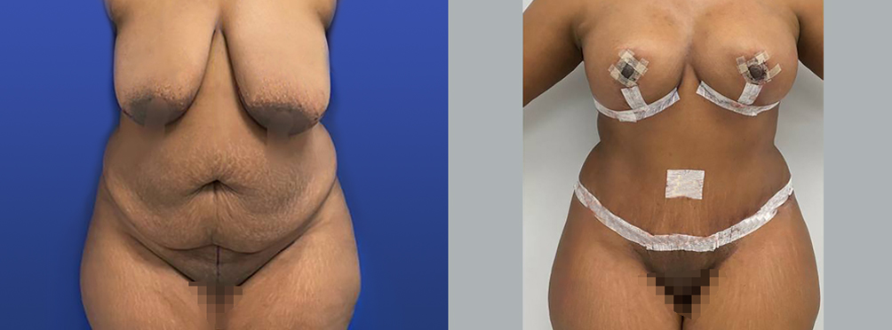 Mommy Makeover Before and After in Miami