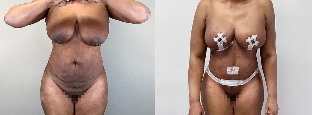 Mommy Makeover Before and After in Miami